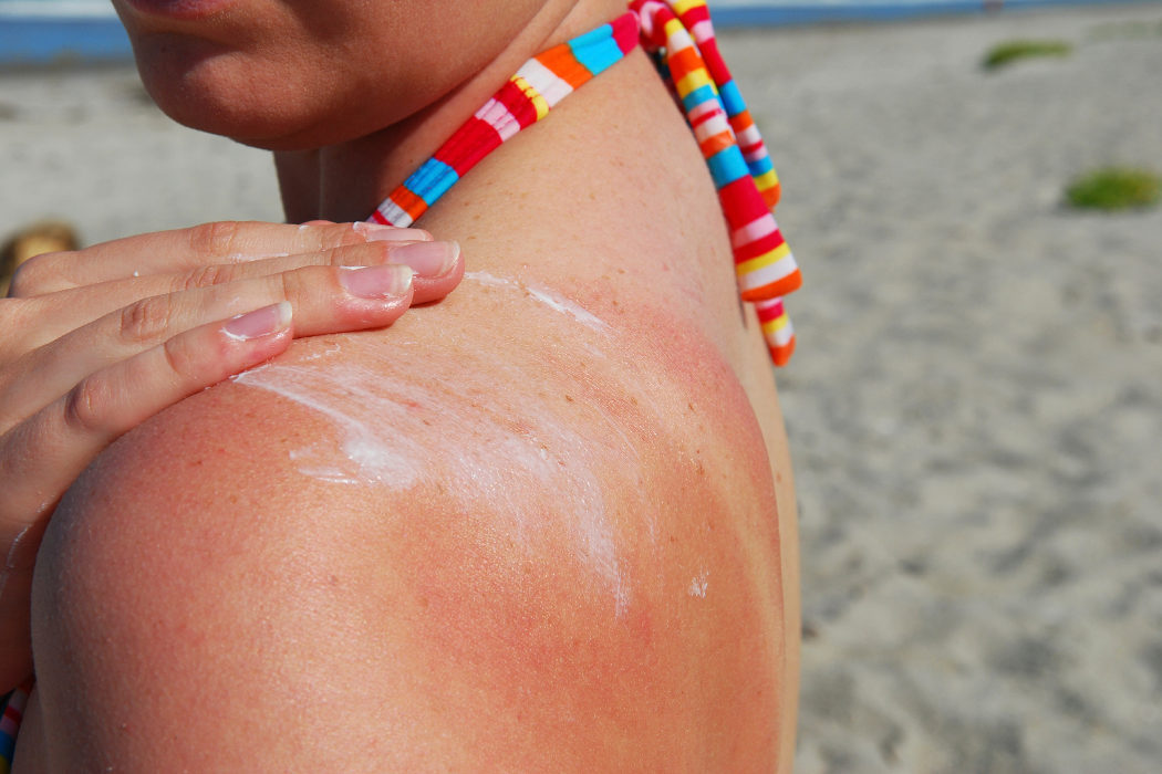 Sunburn Relief