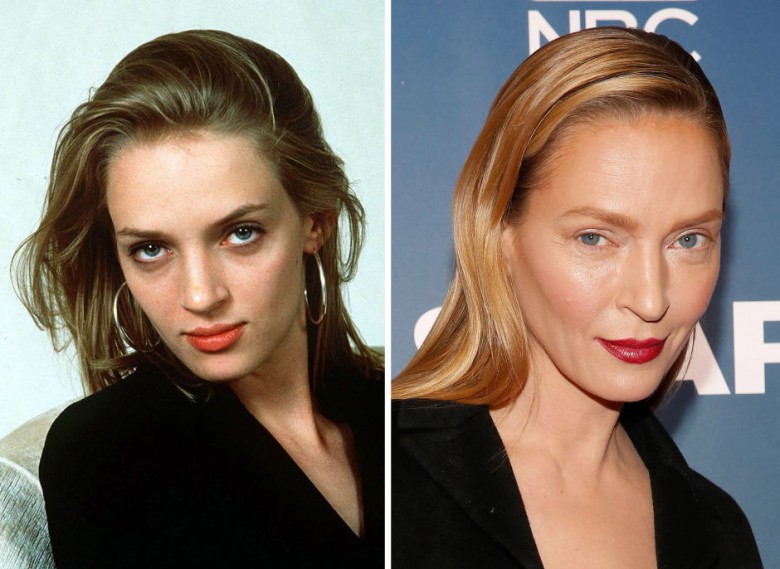 gorgeous-stars-before-and-after-botox-03