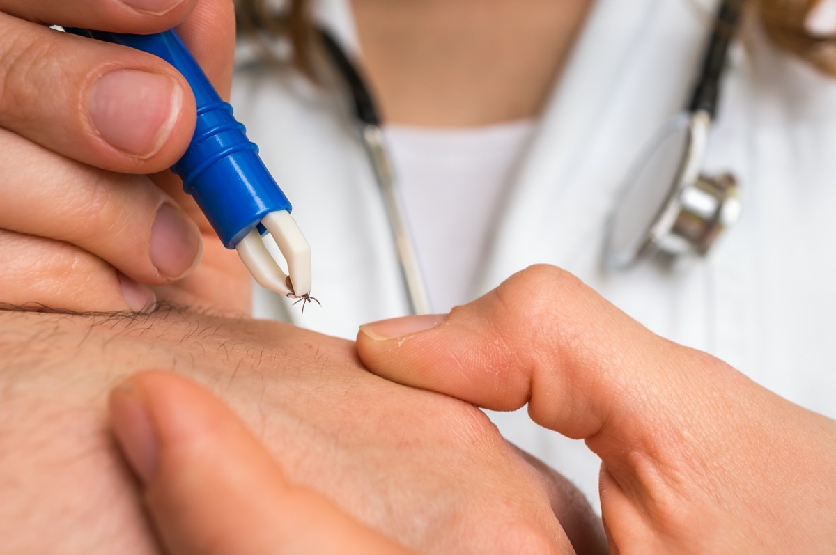 doctor removing tick from skin